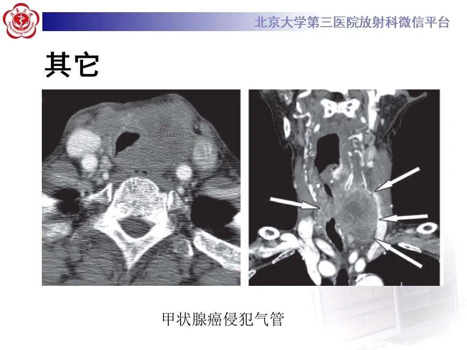 影像PPT - 【PPT】 肺腺样囊性癌的影像-32