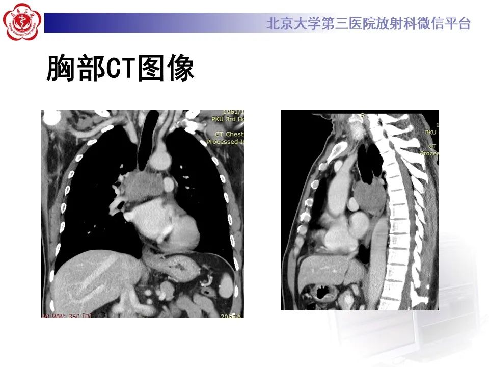 影像PPT - 【PPT】 肺腺样囊性癌的影像-1