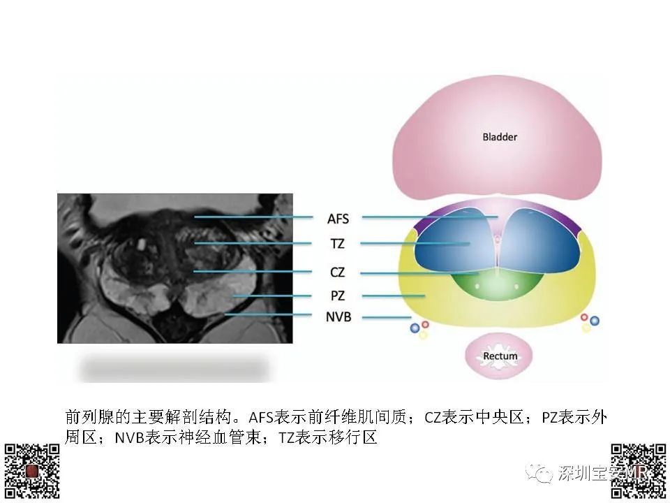 影像PPT - 【PPT】前列腺罕见恶性肿瘤影像表现-5