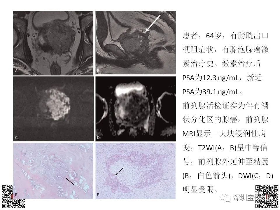 影像PPT - 【PPT】前列腺罕见恶性肿瘤影像表现-11