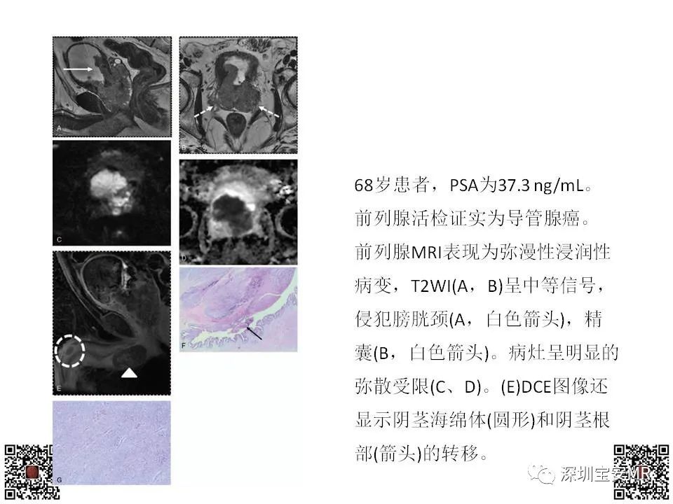 影像PPT - 【PPT】前列腺罕见恶性肿瘤影像表现-13