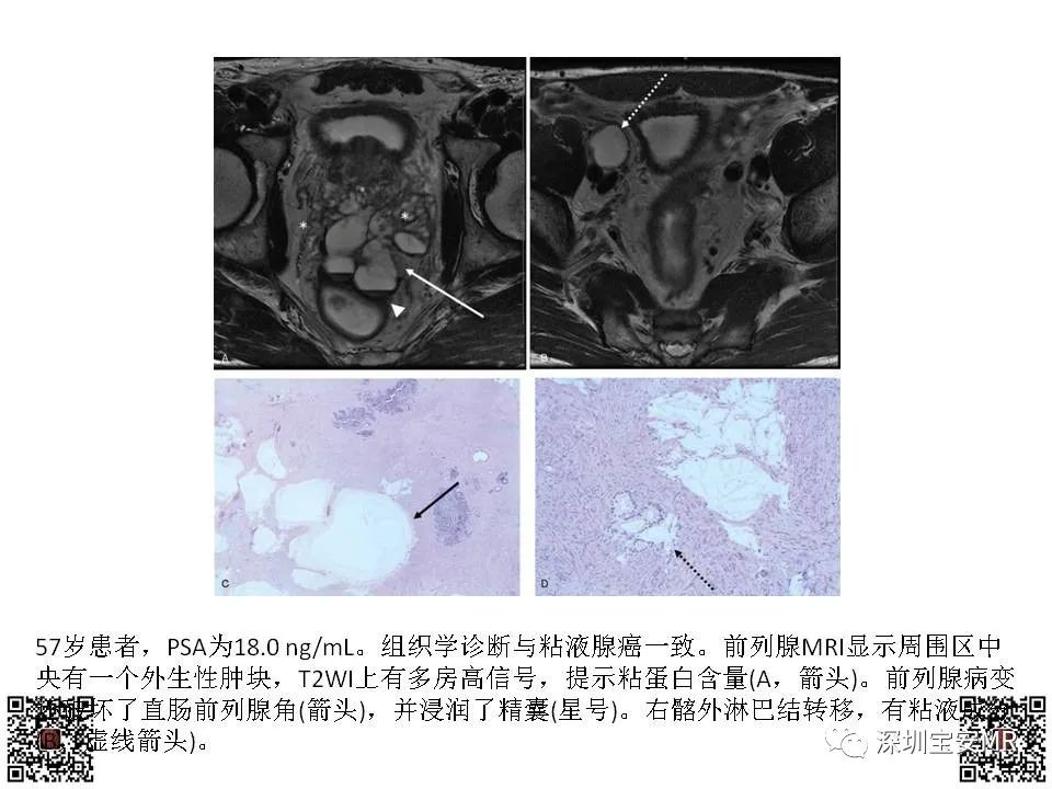 影像PPT - 【PPT】前列腺罕见恶性肿瘤影像表现-15