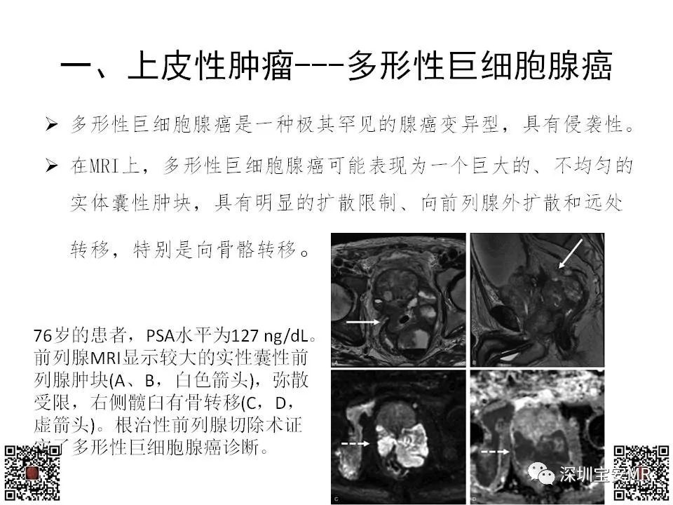影像PPT - 【PPT】前列腺罕见恶性肿瘤影像表现-16