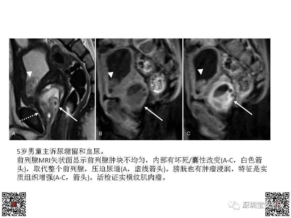 影像PPT - 【PPT】前列腺罕见恶性肿瘤影像表现-20