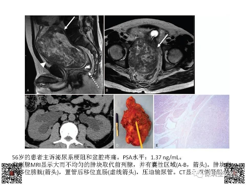影像PPT - 【PPT】前列腺罕见恶性肿瘤影像表现-22