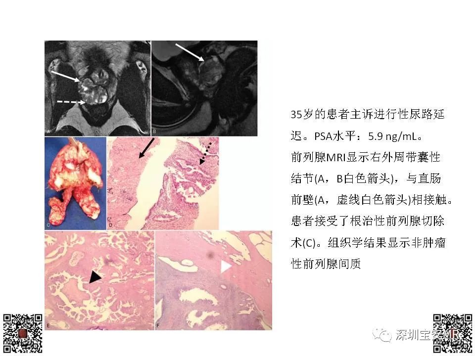 影像PPT - 【PPT】前列腺罕见恶性肿瘤影像表现-24