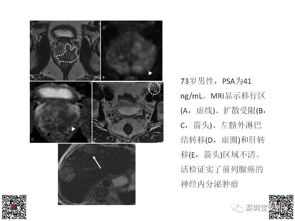 影像PPT - 【PPT】前列腺罕见恶性肿瘤影像表现-26