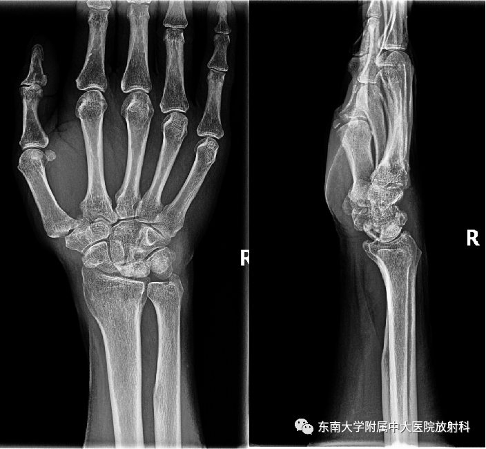 影像PPT - 【PPT】Kienbock病—月骨缺血性坏死-1