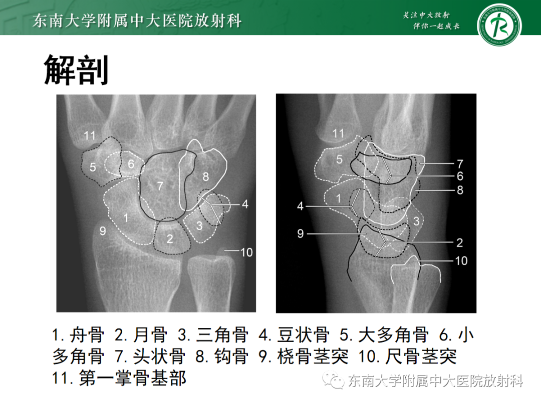 影像PPT - 【PPT】Kienbock病—月骨缺血性坏死-5