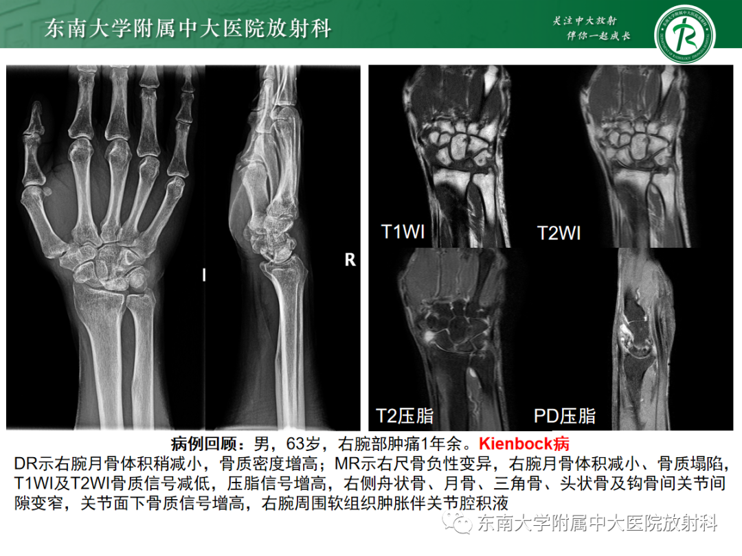 影像PPT - 【PPT】Kienbock病—月骨缺血性坏死-3