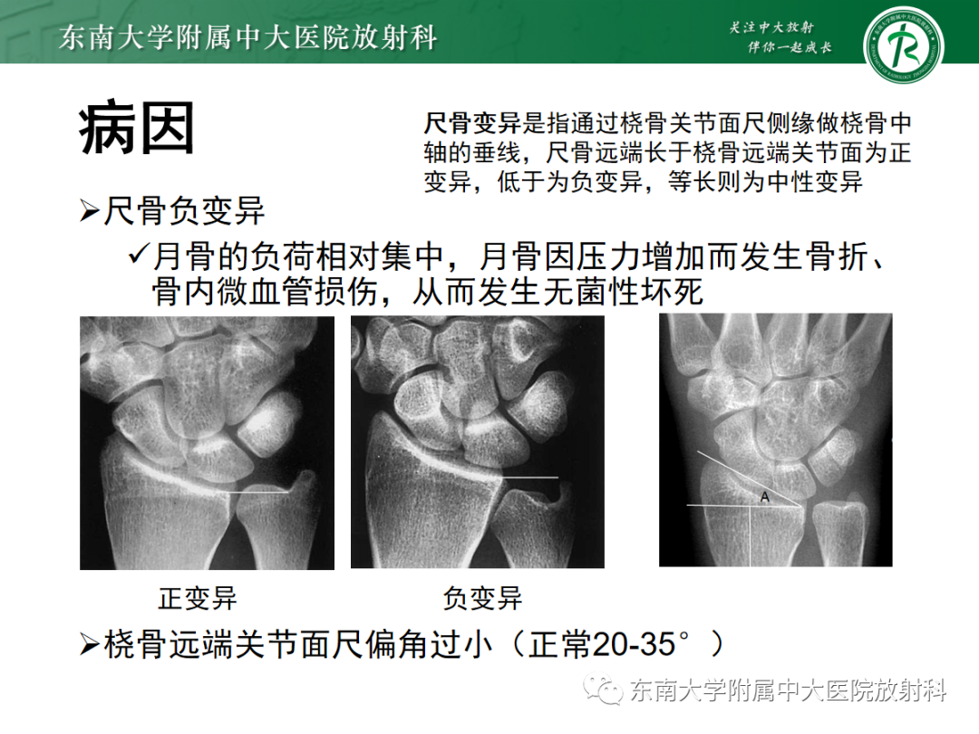 影像PPT - 【PPT】Kienbock病—月骨缺血性坏死-8