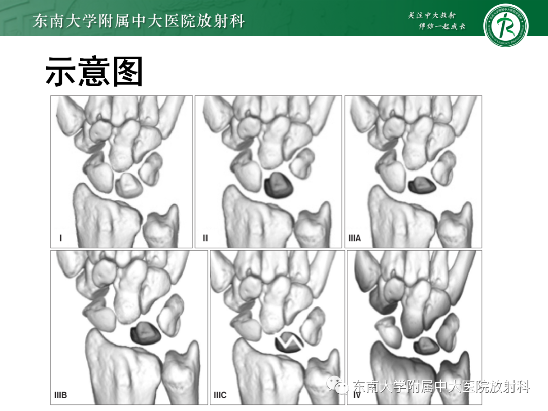 影像PPT - 【PPT】Kienbock病—月骨缺血性坏死-12