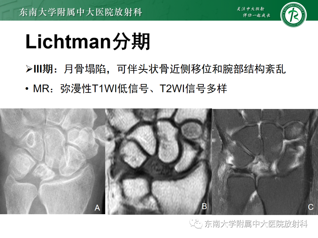 影像PPT - 【PPT】Kienbock病—月骨缺血性坏死-15