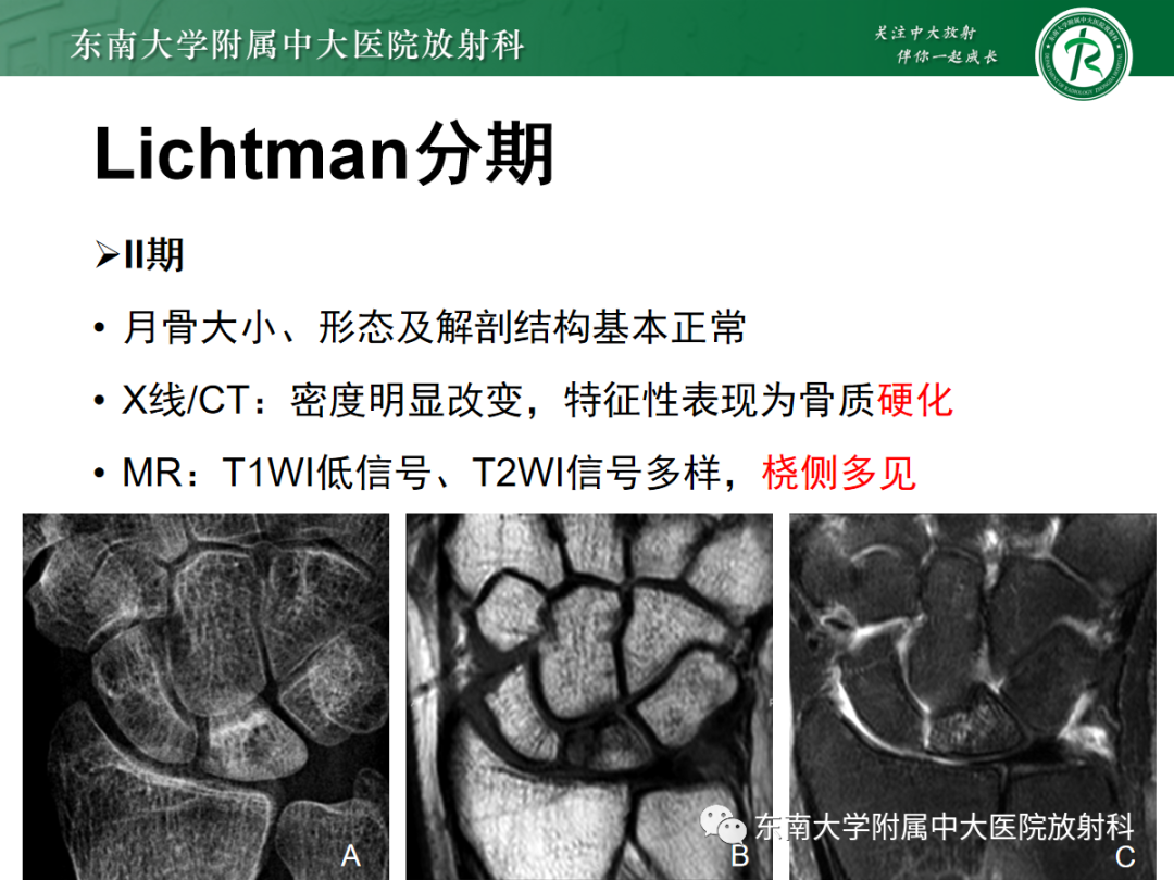 影像PPT - 【PPT】Kienbock病—月骨缺血性坏死-14