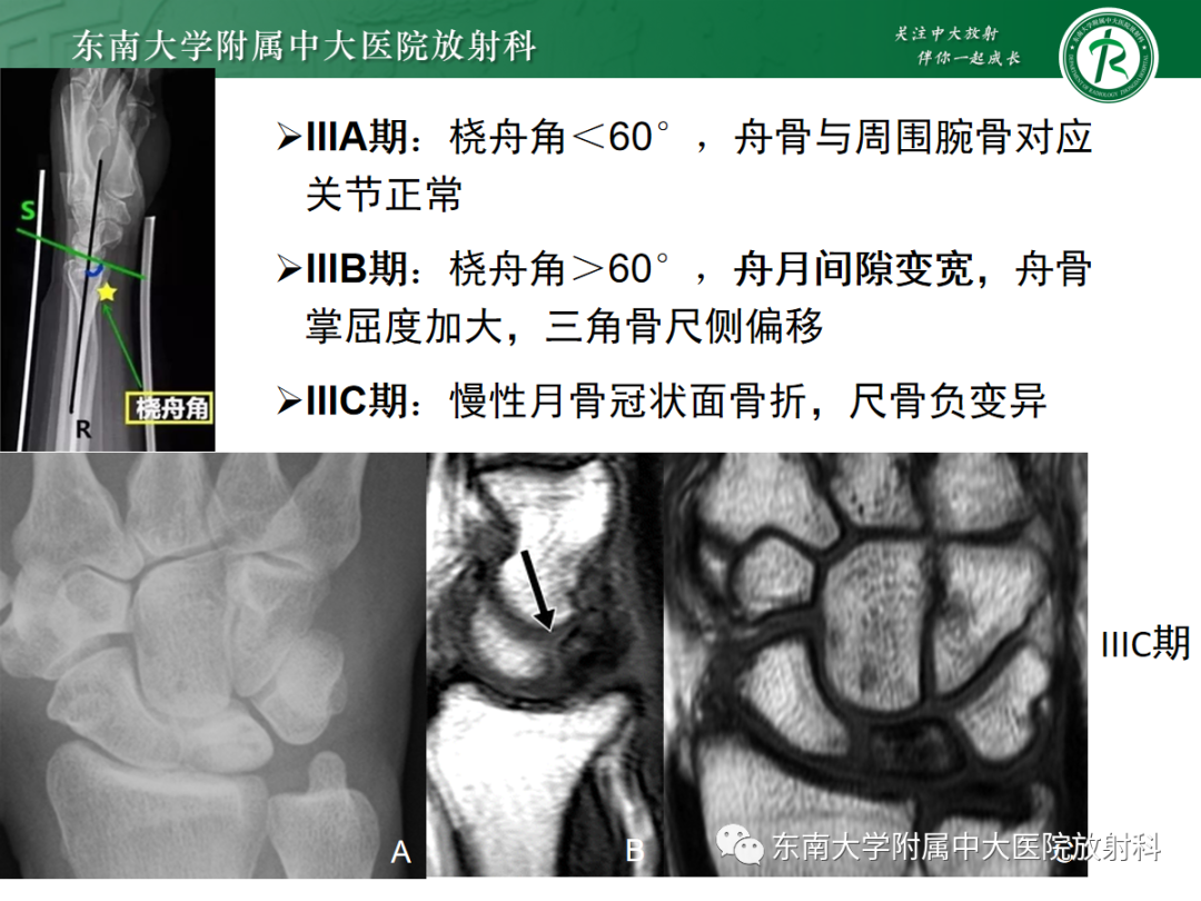 影像PPT - 【PPT】Kienbock病—月骨缺血性坏死-16
