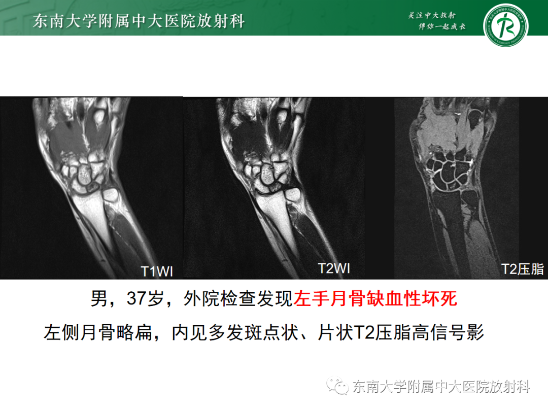 影像PPT - 【PPT】Kienbock病—月骨缺血性坏死-18