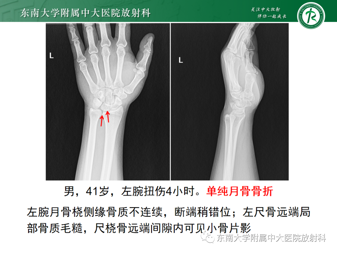 影像PPT - 【PPT】Kienbock病—月骨缺血性坏死-23