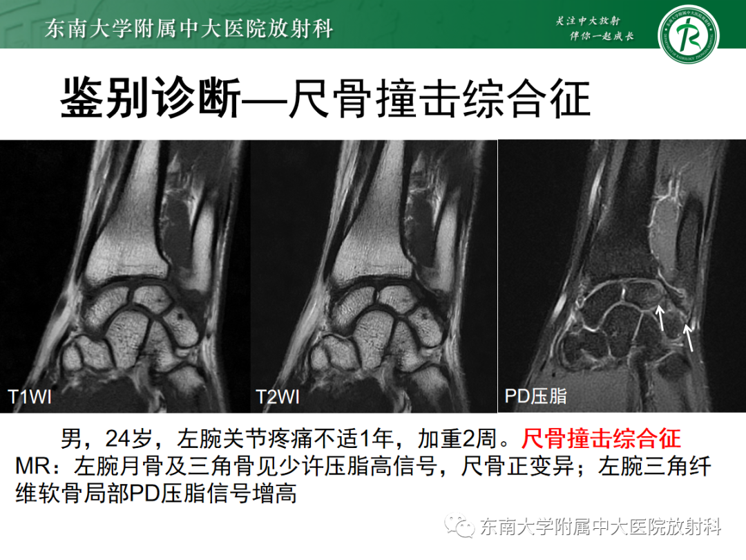 影像PPT - 【PPT】Kienbock病—月骨缺血性坏死-25