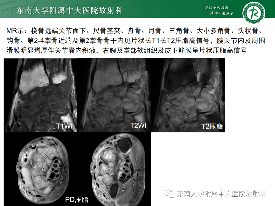 影像PPT - 【PPT】Kienbock病—月骨缺血性坏死-28