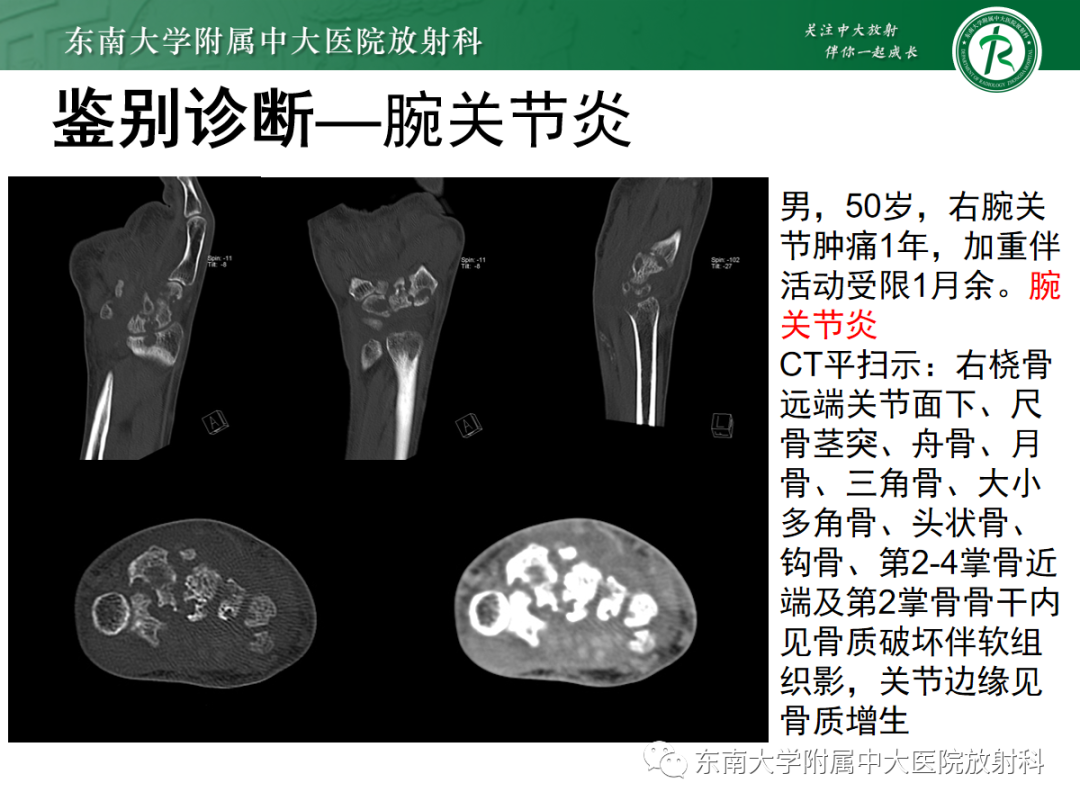 影像PPT - 【PPT】Kienbock病—月骨缺血性坏死-27