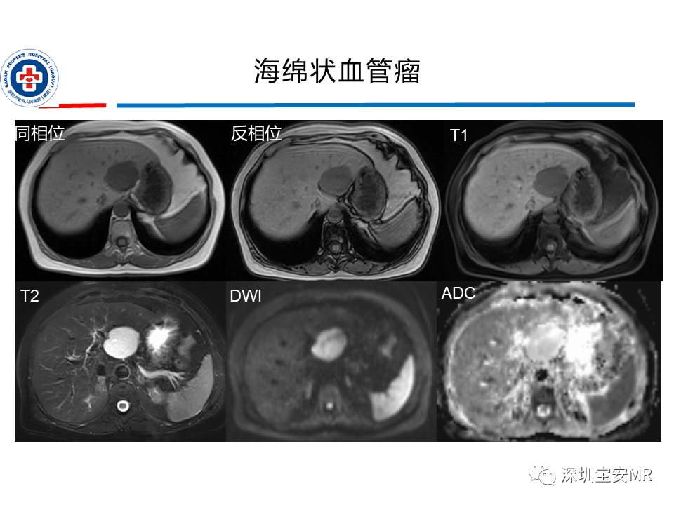 影像PPT - 【PPT】肝脏常见肿瘤MRI诊断与鉴别诊断-9