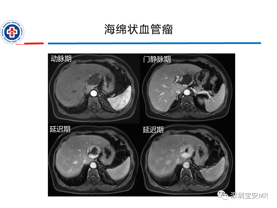 影像PPT - 【PPT】肝脏常见肿瘤MRI诊断与鉴别诊断-10