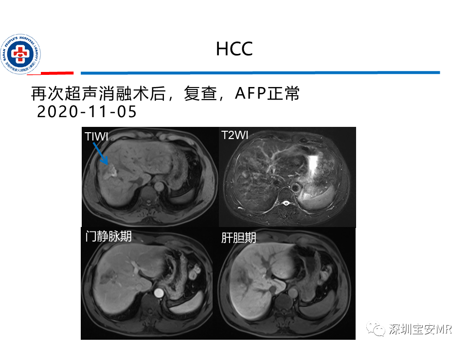 影像PPT - 【PPT】肝脏常见肿瘤MRI诊断与鉴别诊断-28