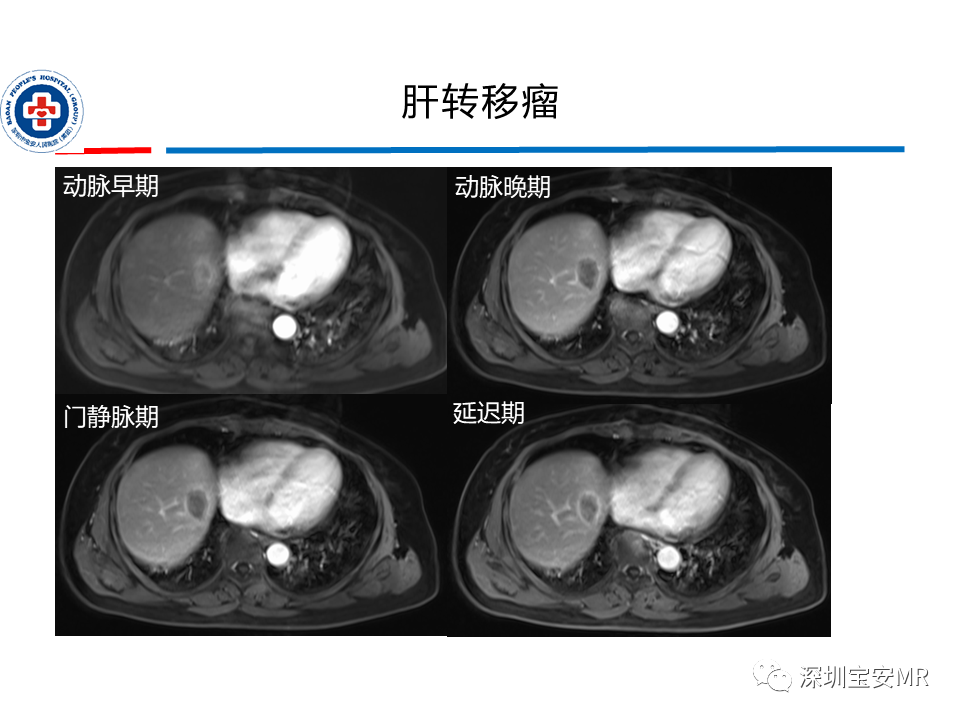 影像PPT - 【PPT】肝脏常见肿瘤MRI诊断与鉴别诊断-34