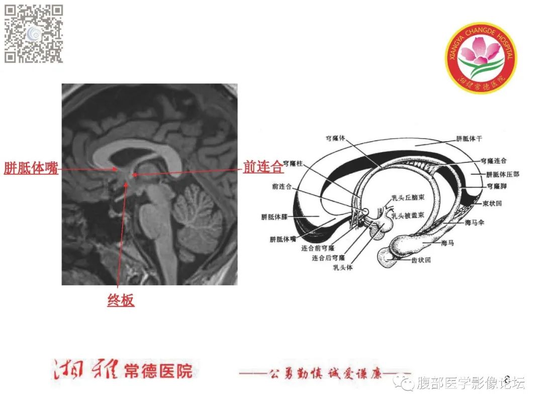 影像PPT - 【PPT】脑中线结构区域解剖及病变影像-6