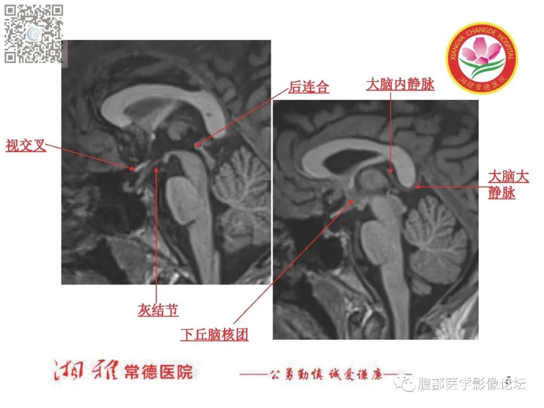 影像PPT - 【PPT】脑中线结构区域解剖及病变影像-5