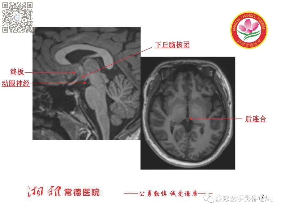 影像PPT - 【PPT】脑中线结构区域解剖及病变影像-7