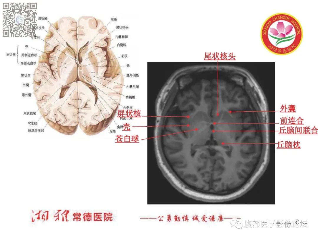 影像PPT - 【PPT】脑中线结构区域解剖及病变影像-8