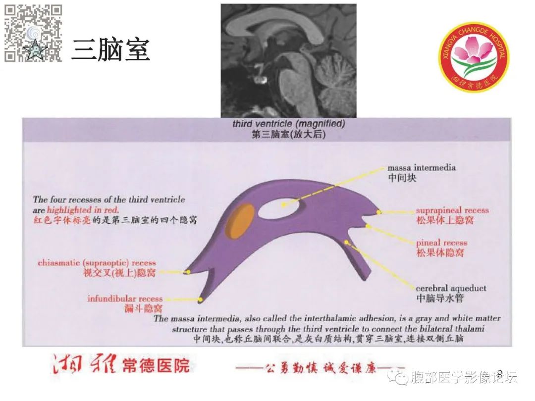 影像PPT - 【PPT】脑中线结构区域解剖及病变影像-9