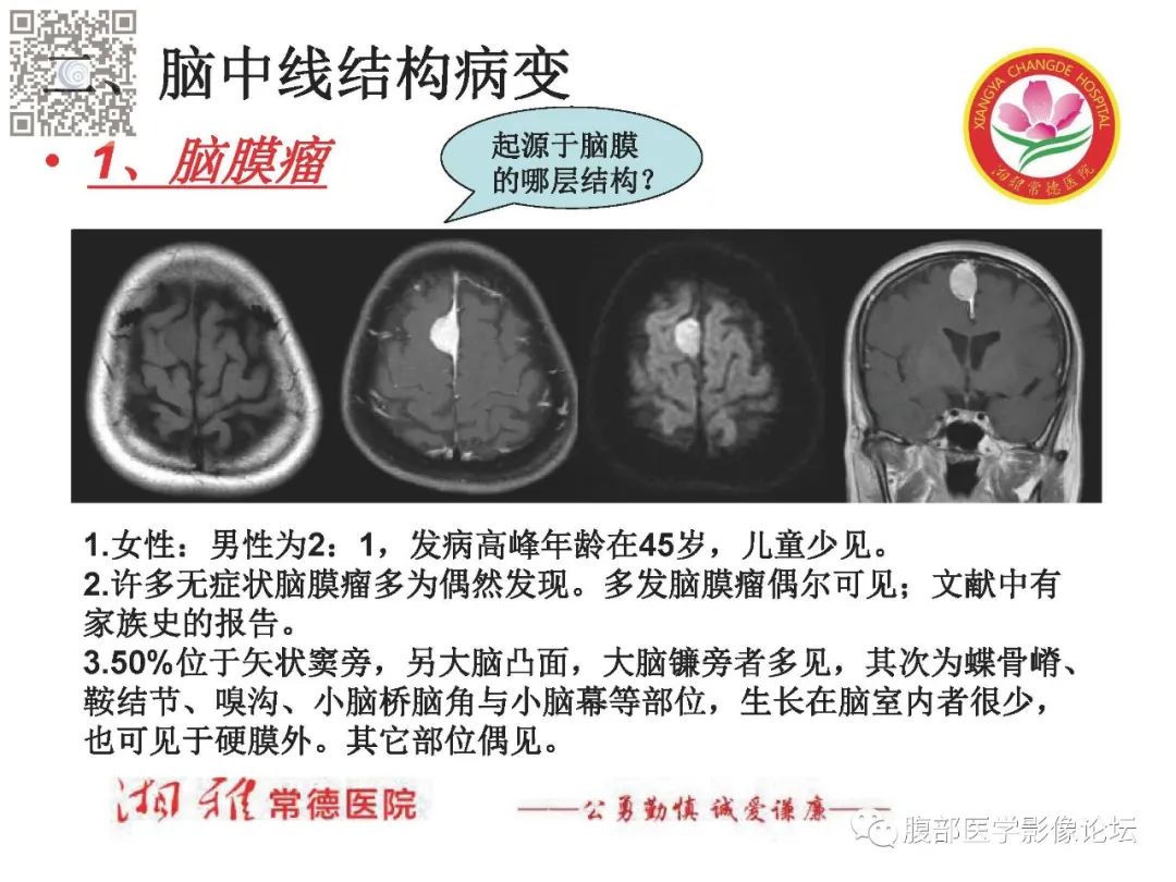 影像PPT - 【PPT】脑中线结构区域解剖及病变影像-13