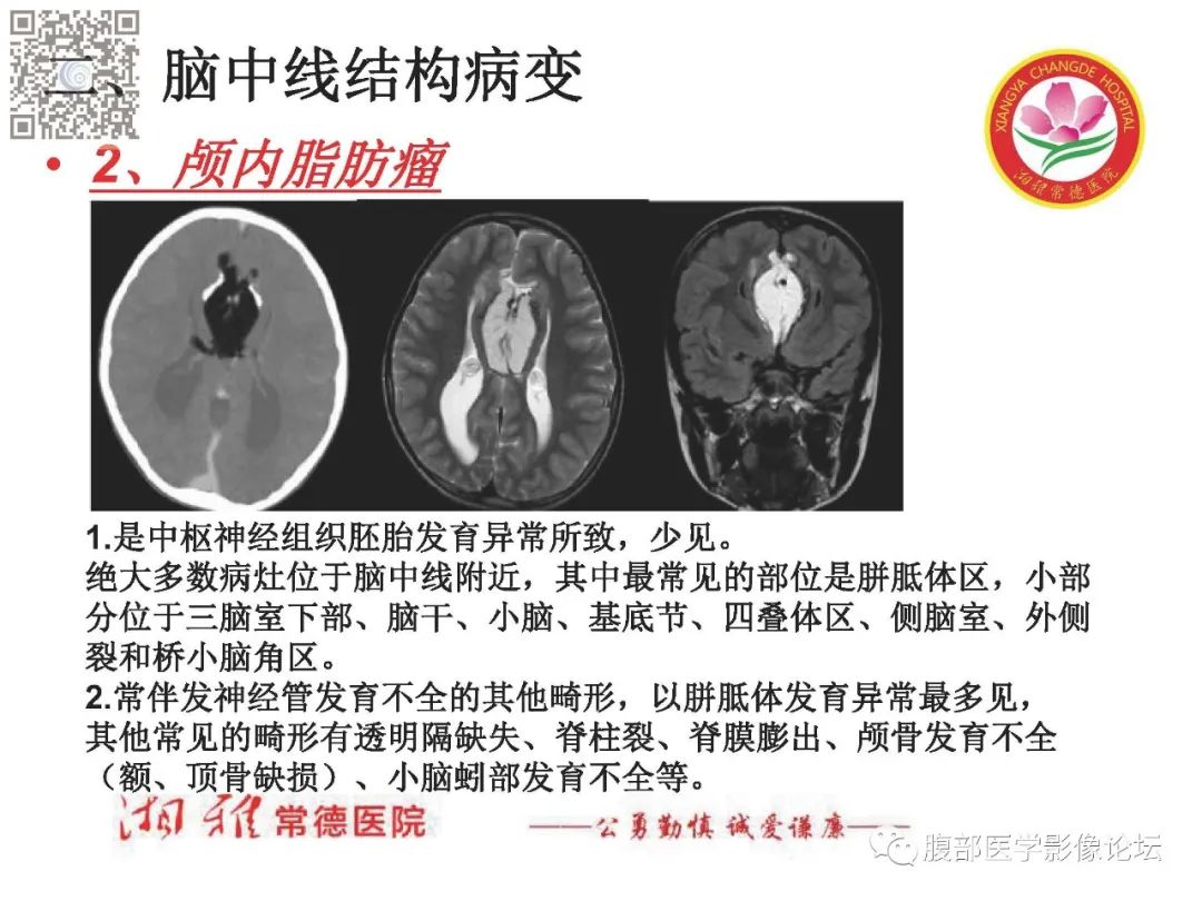 影像PPT - 【PPT】脑中线结构区域解剖及病变影像-14