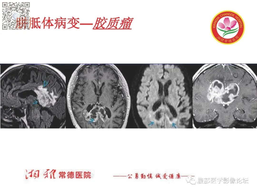 影像PPT - 【PPT】脑中线结构区域解剖及病变影像-18