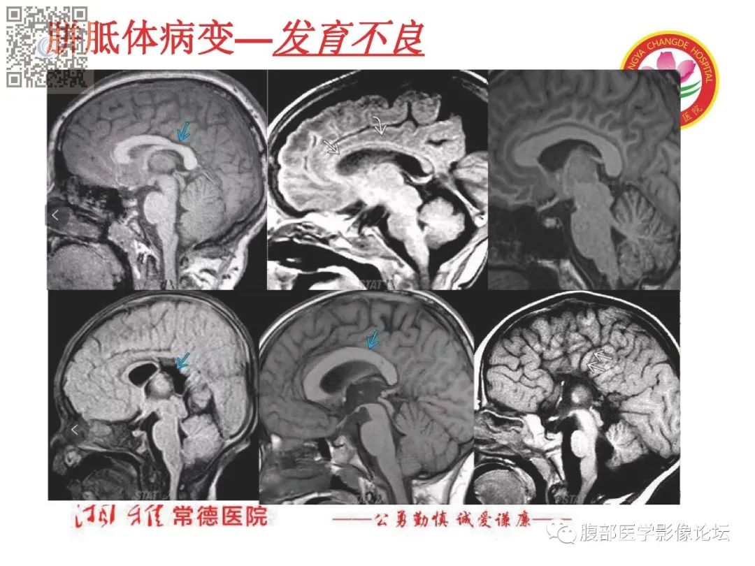 影像PPT - 【PPT】脑中线结构区域解剖及病变影像-17