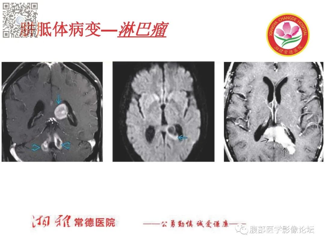 影像PPT - 【PPT】脑中线结构区域解剖及病变影像-19