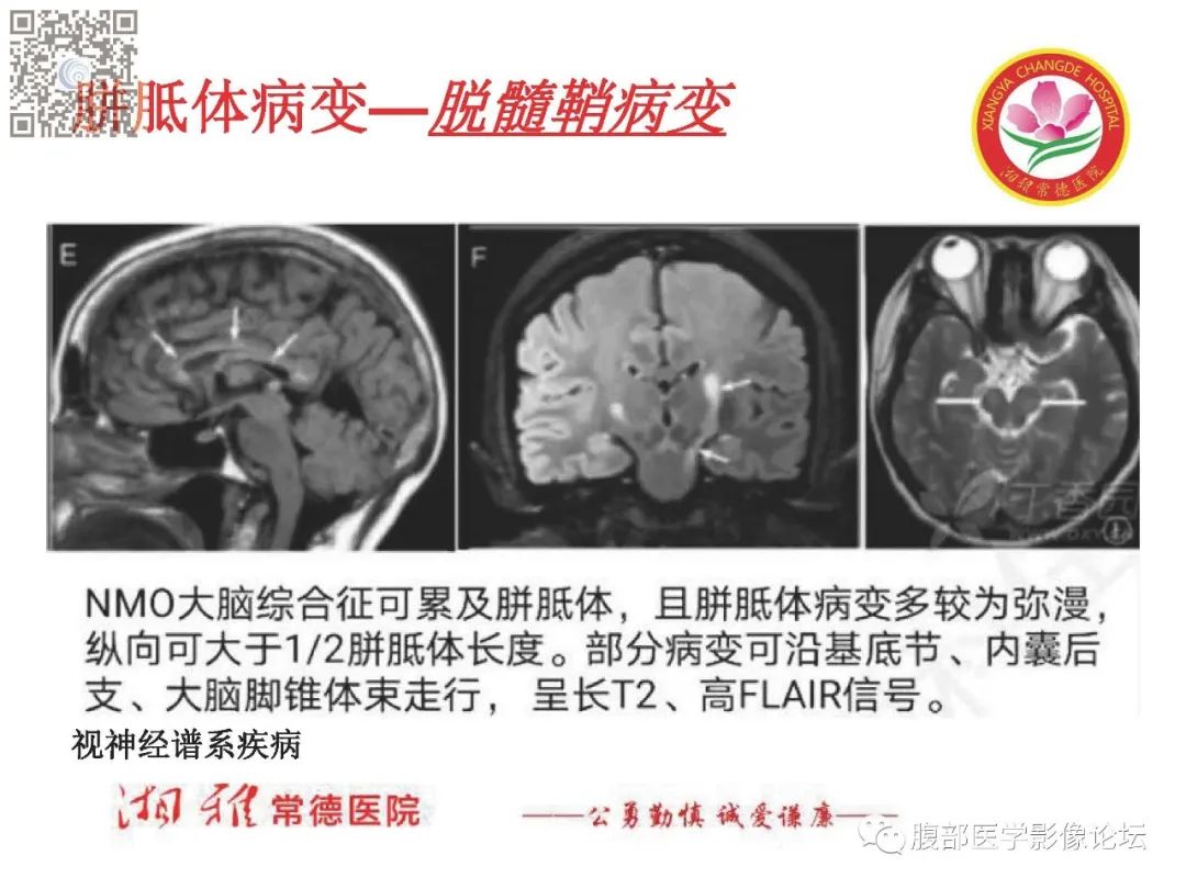 影像PPT - 【PPT】脑中线结构区域解剖及病变影像-24
