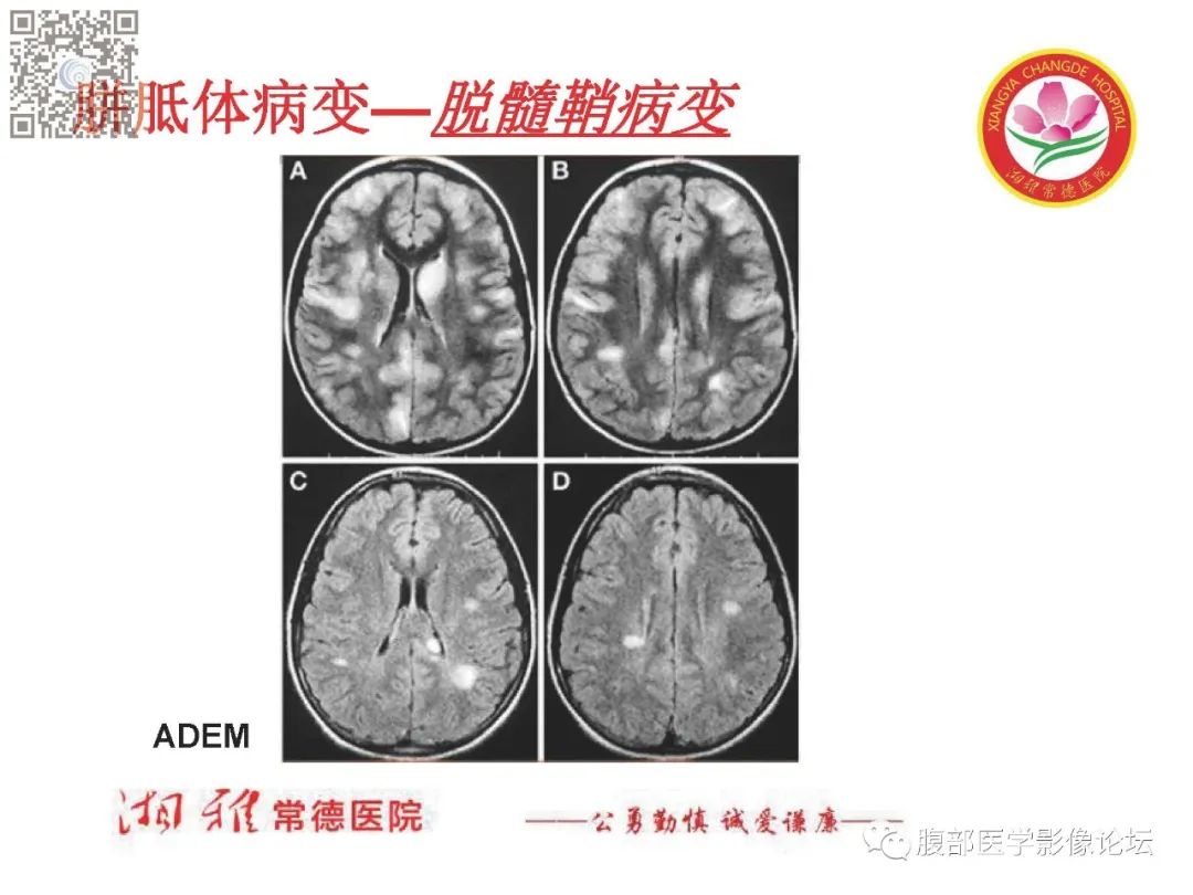 影像PPT - 【PPT】脑中线结构区域解剖及病变影像-22