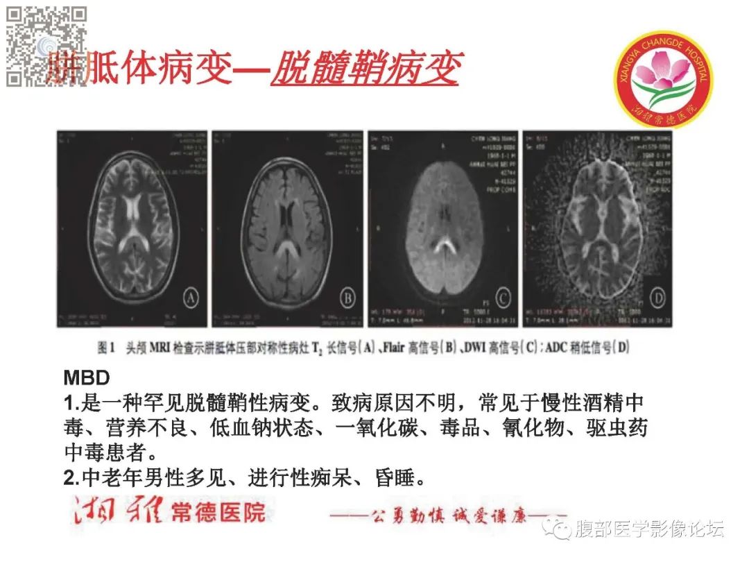 影像PPT - 【PPT】脑中线结构区域解剖及病变影像-20