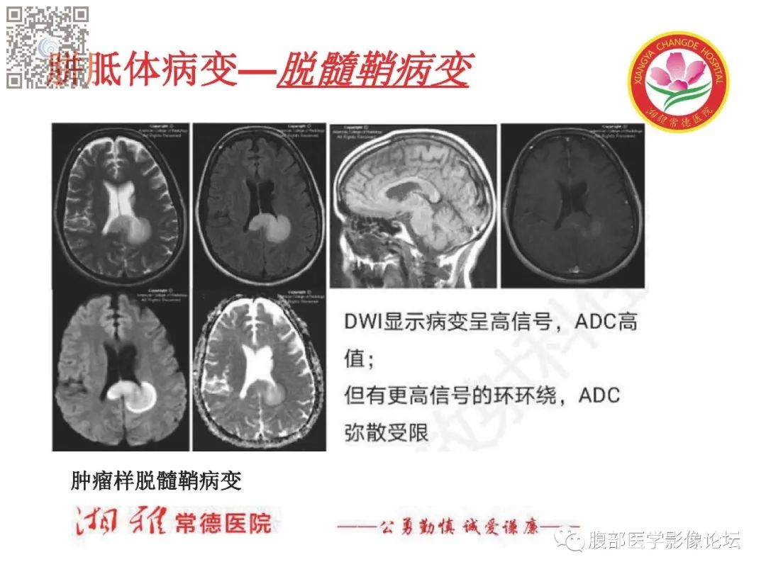 影像PPT - 【PPT】脑中线结构区域解剖及病变影像-23