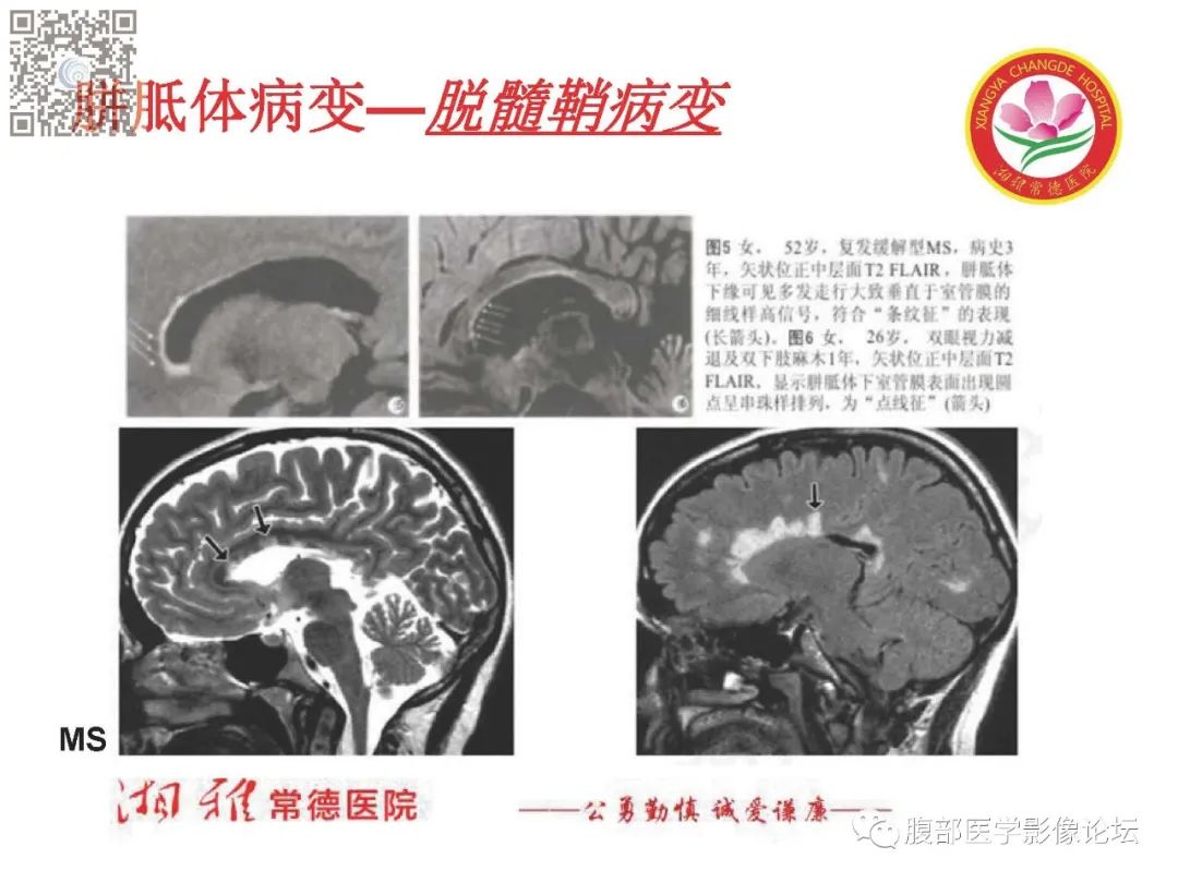 影像PPT - 【PPT】脑中线结构区域解剖及病变影像-21