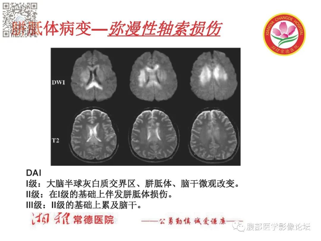 影像PPT - 【PPT】脑中线结构区域解剖及病变影像-26