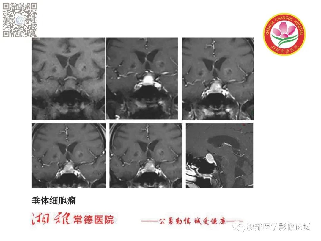 影像PPT - 【PPT】脑中线结构区域解剖及病变影像-31