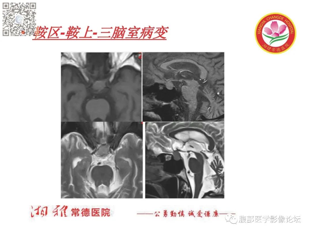 影像PPT - 【PPT】脑中线结构区域解剖及病变影像-30