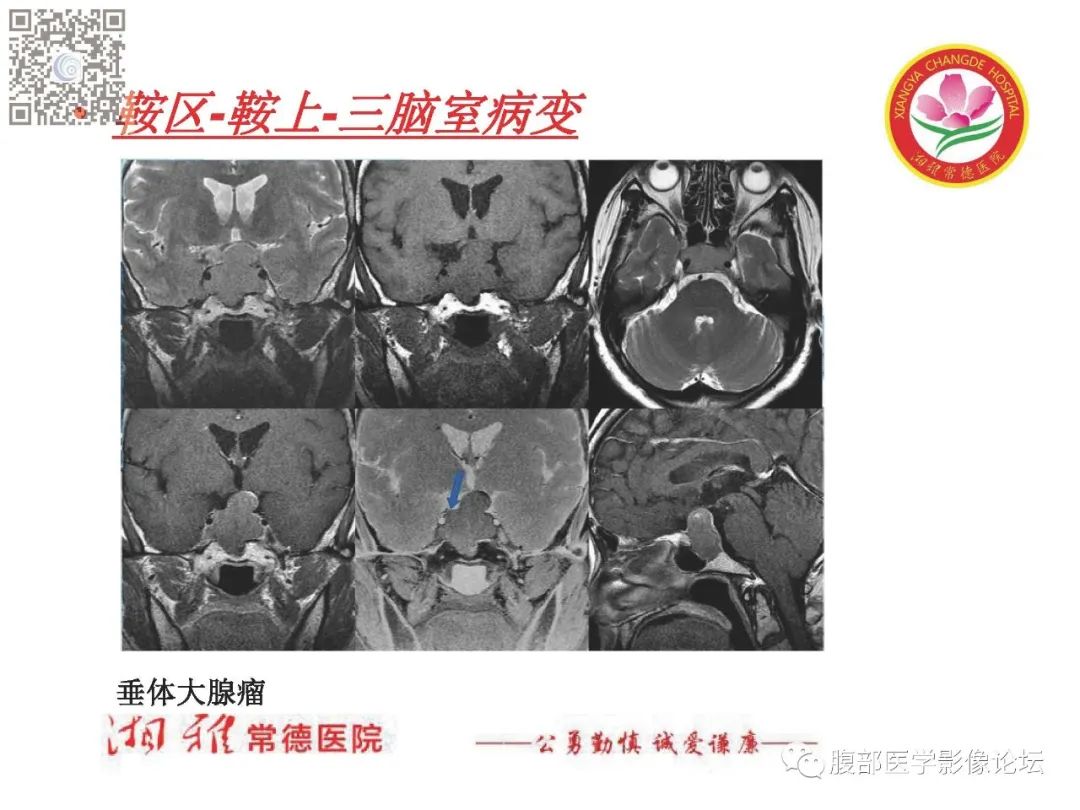 影像PPT - 【PPT】脑中线结构区域解剖及病变影像-29