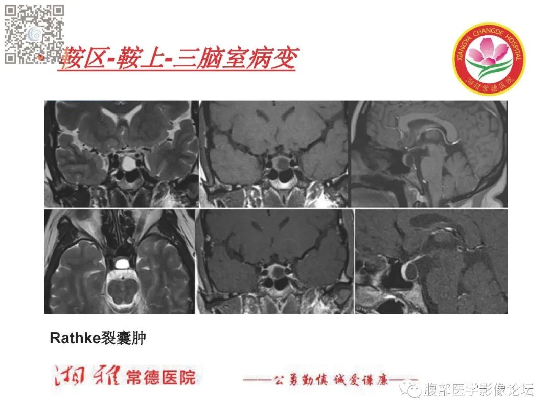 影像PPT - 【PPT】脑中线结构区域解剖及病变影像-32