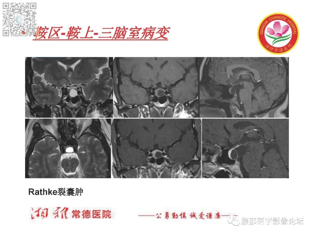影像PPT - 【PPT】脑中线结构区域解剖及病变影像-33