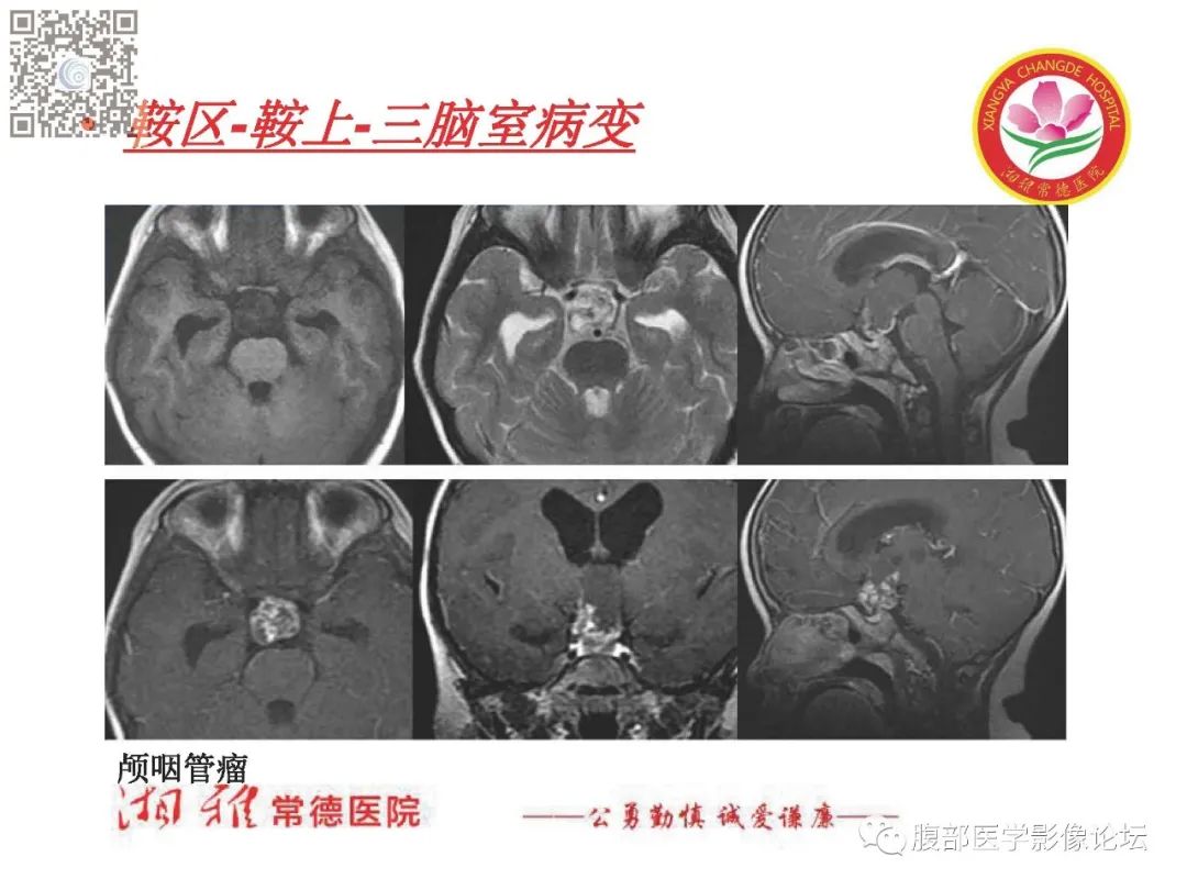 影像PPT - 【PPT】脑中线结构区域解剖及病变影像-35